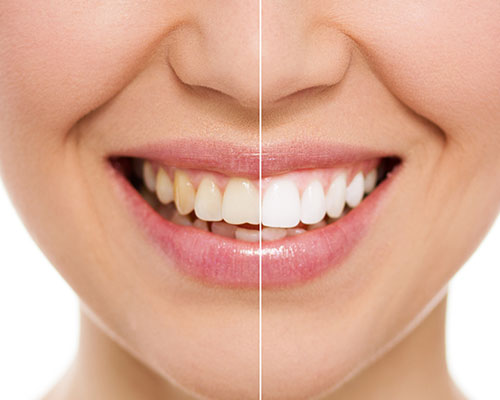 before and after teeth whitening comparison photo